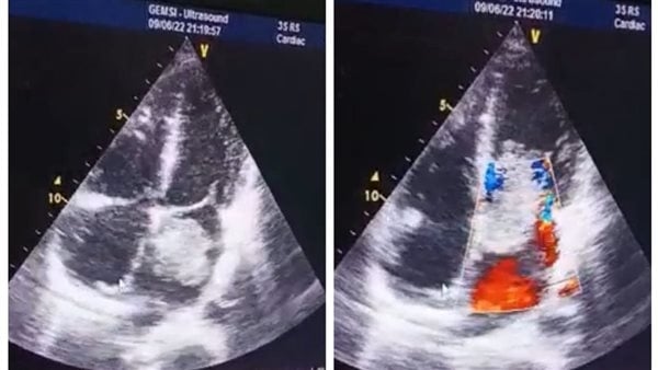 فريق طبي بجامعة أسيوط يجري جراحة معقدة لمريض يعاني من ورم بالقلب