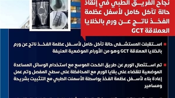 نجاح فريق طبي بمستشفى النيل في إنقاذ مريضة تعاني من ورم الخلايا العملاقة