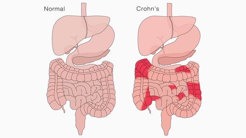 Fast Five Quiz: Identify and Treat Crohn's Disease