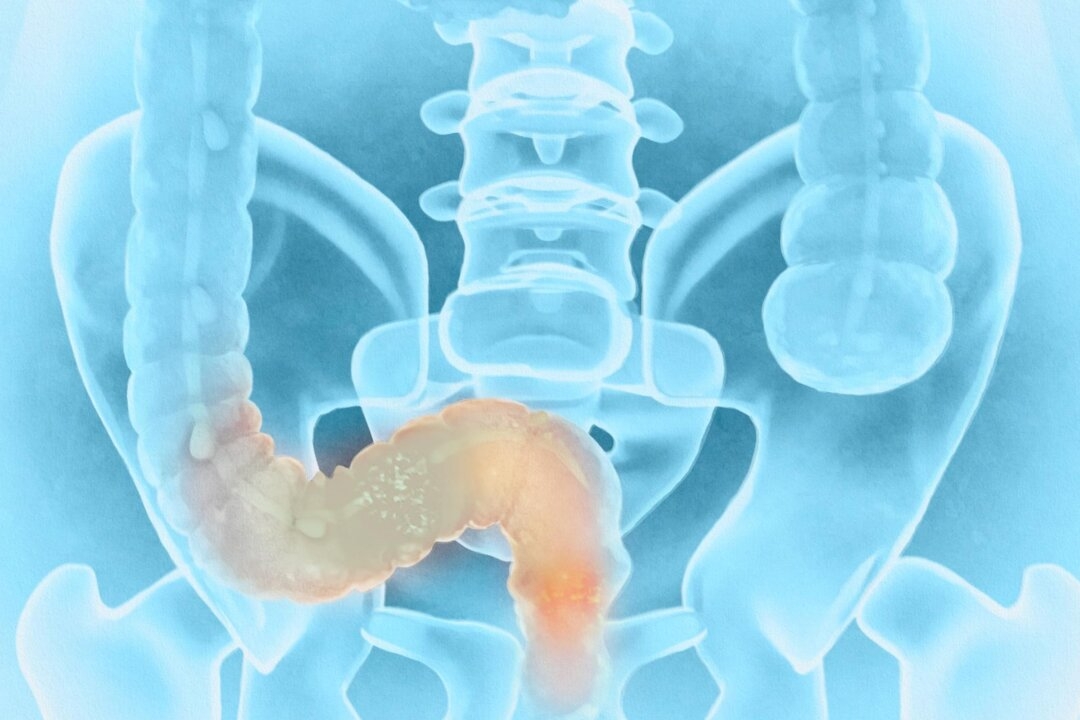 Screening Initiative Cuts Down Colorectal Cancer Rates, Deaths by 50 Percent