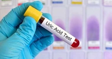 ارتفاع حمض اليوريك.. 5 أطعمة تجنبها ونصائح للحفاظ على صحة الكلى