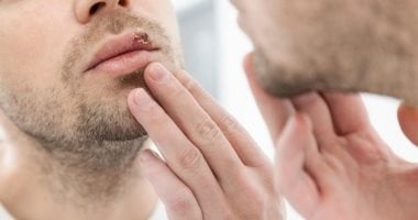 ما هو الهربس الفموى وطرق علاجه