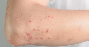 دراسة: لقاحات الحزام النارى تساهم فى خفض الإصابة بالخرف بنسبة 20%