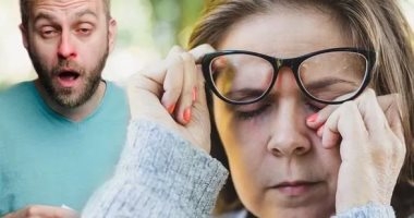 في الأتربة.. أكلات تزيد الحساسية بلاش منها وأخرى صحية