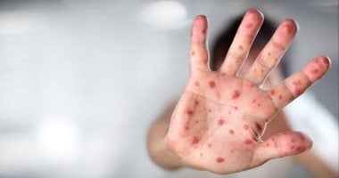 لماذا يخلط البعض بين فيروس كوكساكي والجديري المائي.. طبيب طرق التفرقة