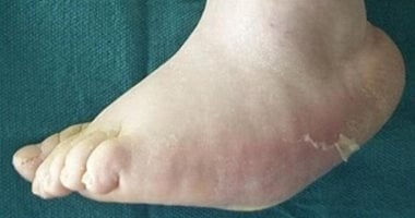 ما هى قدم شاركوت فى مرض السكرى وكيف تسبب تدمير العظام؟