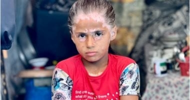 "لا أحد يحبني".. صرخة لانا الشريف بعد إصابتها بـ"البهاق" بسبب الاحتلال.. وجهها البرئ تحول لجلد وشعر أبيض.. والدتها: تتعرض للتنمر وتعيش خوف وتعب دائم بسبب حالتها النفسية السيئة وأتمنى عودة وجهها الجميل.. صور