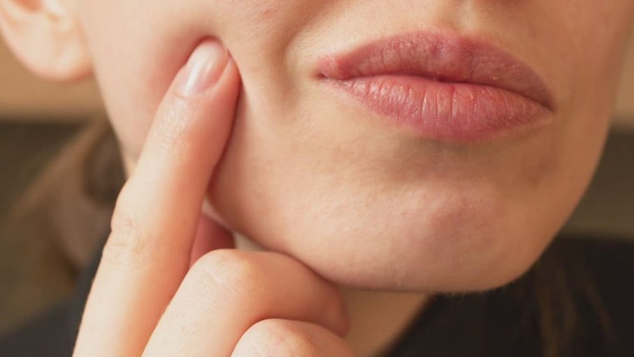 أدوية علاج الهربس قد تُخفض خطر الإصابة بألزهايمر