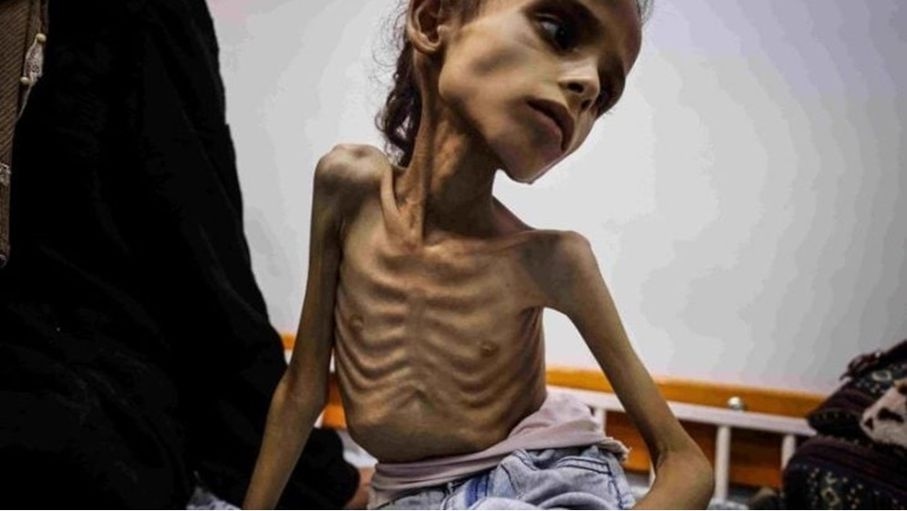 صحة غزة: ارتفاع وفيات التجويع الإسرائيلي إلى 193 بينهم 96 طفلا