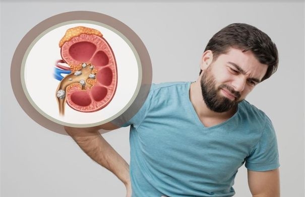 حصوات الكلى في رمضان: 9 نصائح للوقاية منها