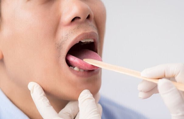 أعراض مبكرة لسرطان الفم لا يجب تجاهلها