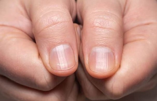5 أعراض تحذيرية للنوبة القلبية قد تظهر على أظافرك