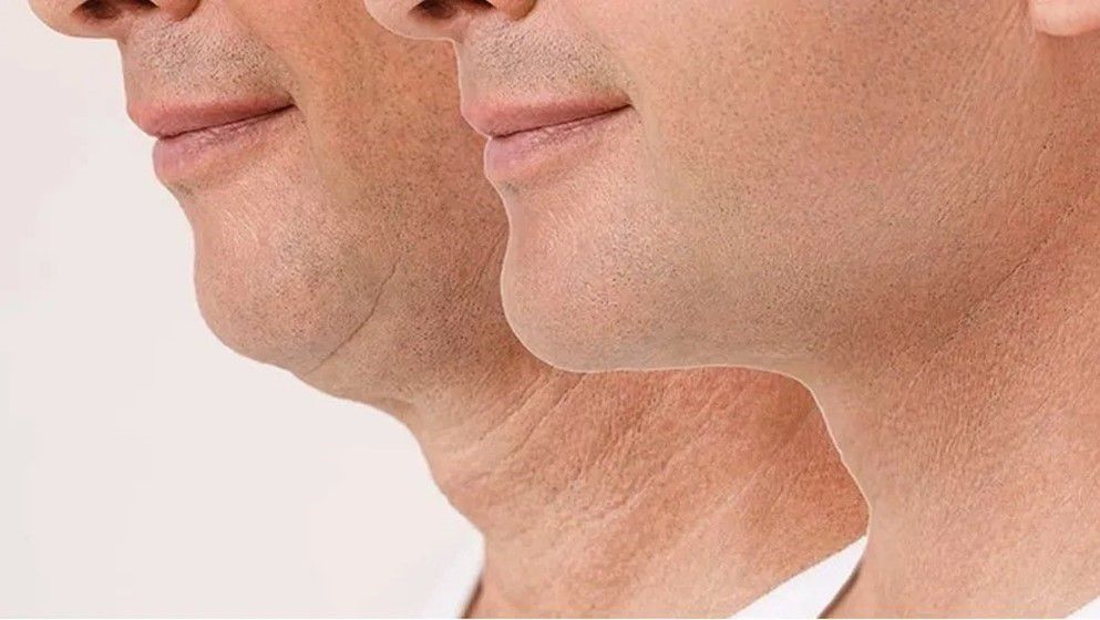 "Turkey Neck" Leads Cosmetic Surgery Trends Among Men - Jordan News