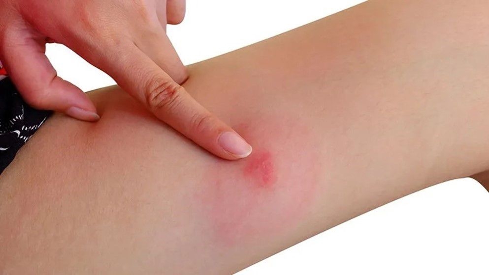 Blood Type of People More Susceptible to Tick Bites - Jordan News