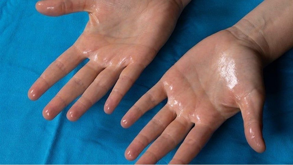 When is Excessive Sweating Dangerous? - Jordan News