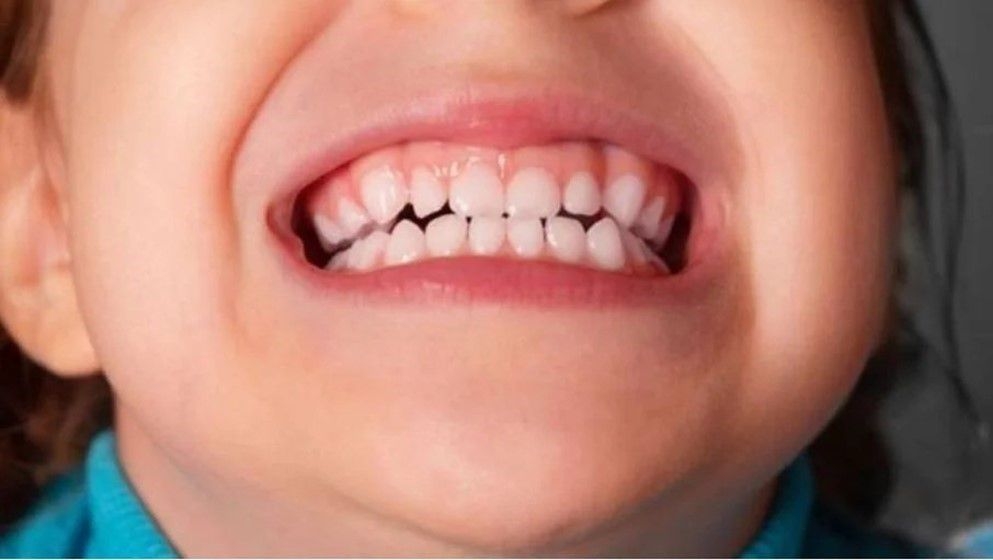 Vitamin D Deficiency: The Silent Killer of Children's Tooth Enamel? - Jordan News