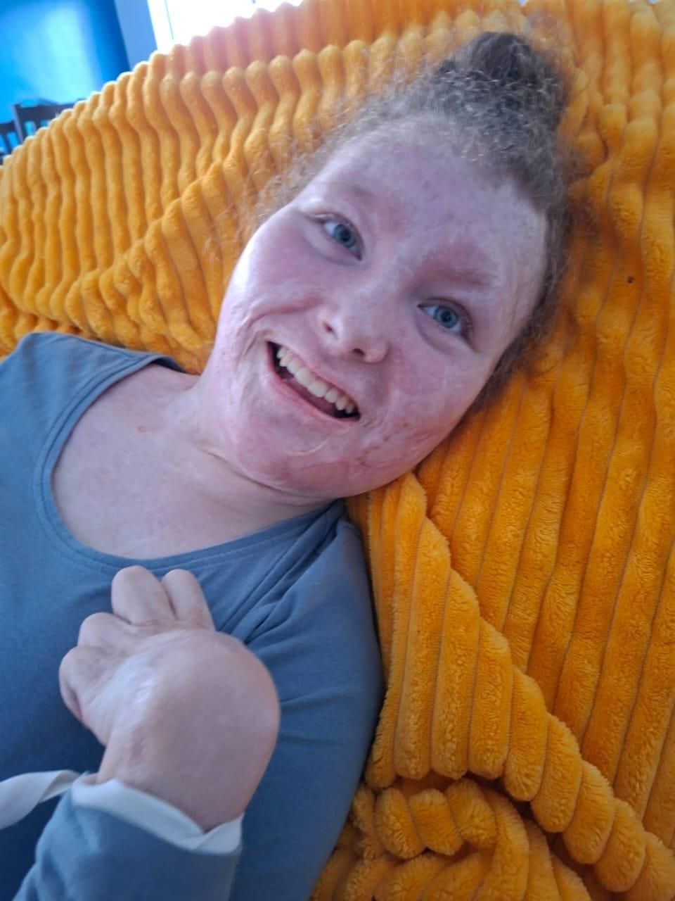 The inspiring story of Pippie Kruger: A resilient burn survivor celebrating her 16th birthday