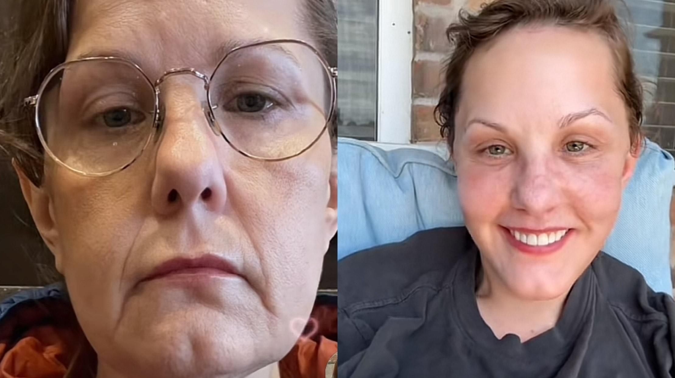 From tired to terrific: watch this woman's viral TikTok facelift transformation
