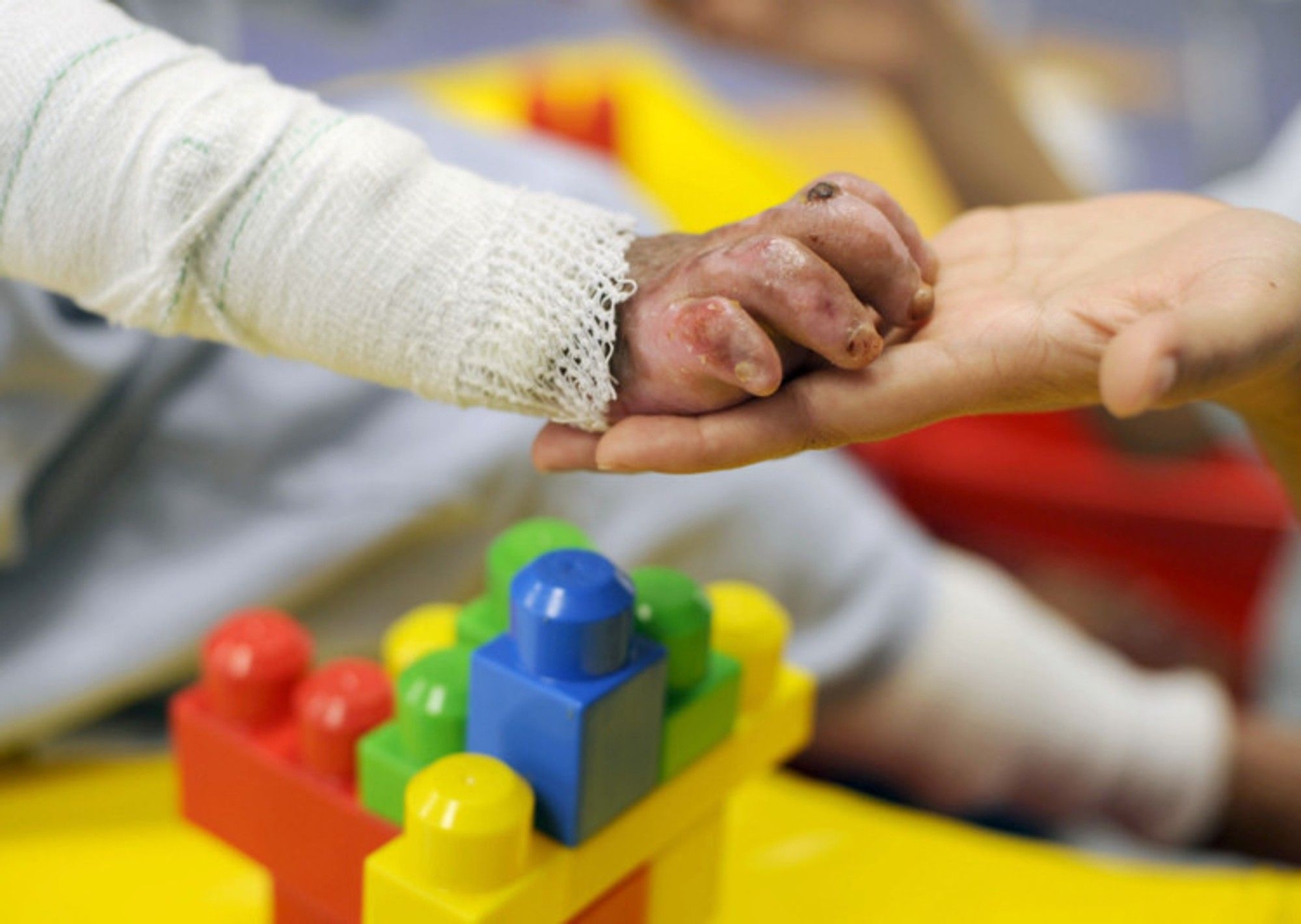 Essential tips to prevent children getting burned