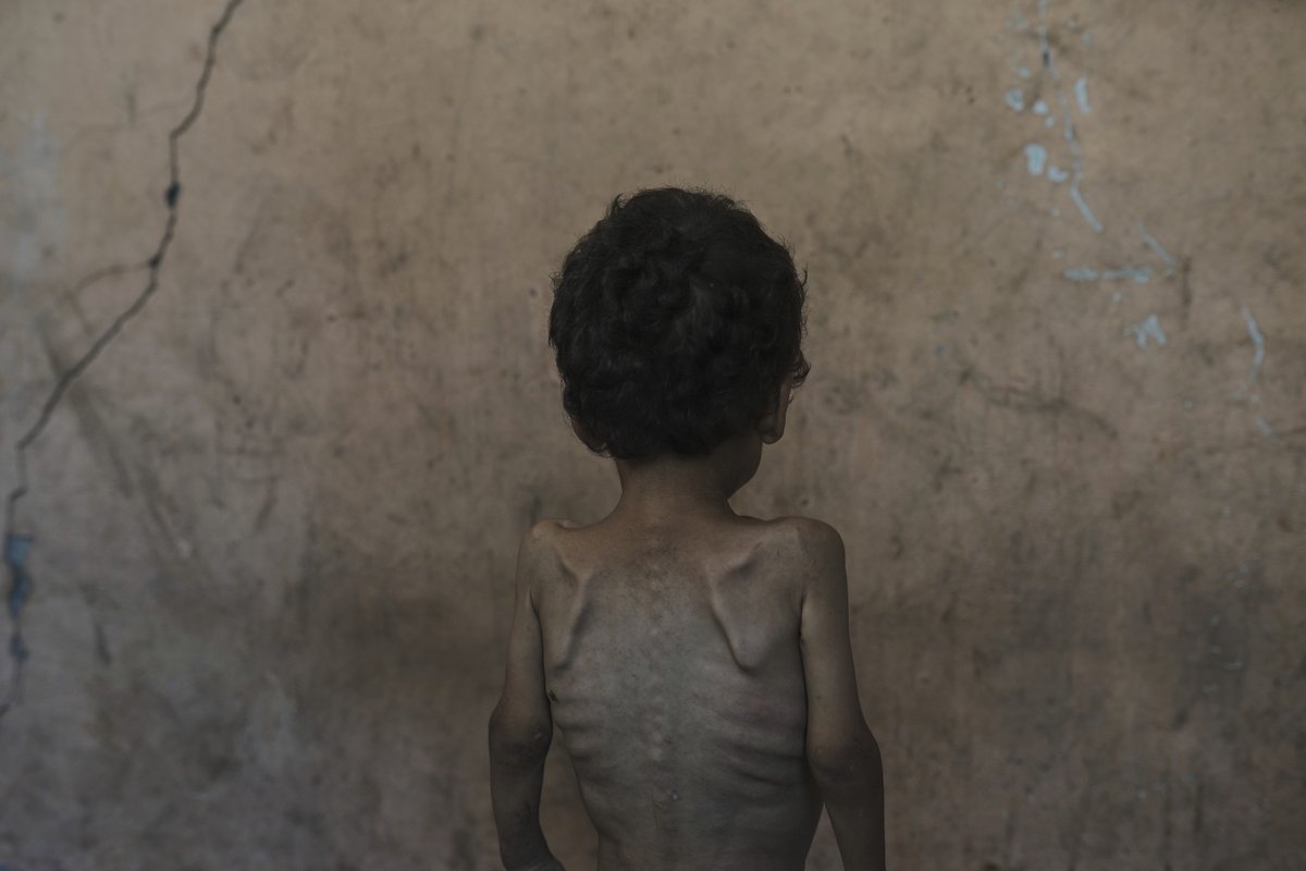 Israel's Leader Claims No One in Gaza Is Starving. Data and Witnesses Disagree
