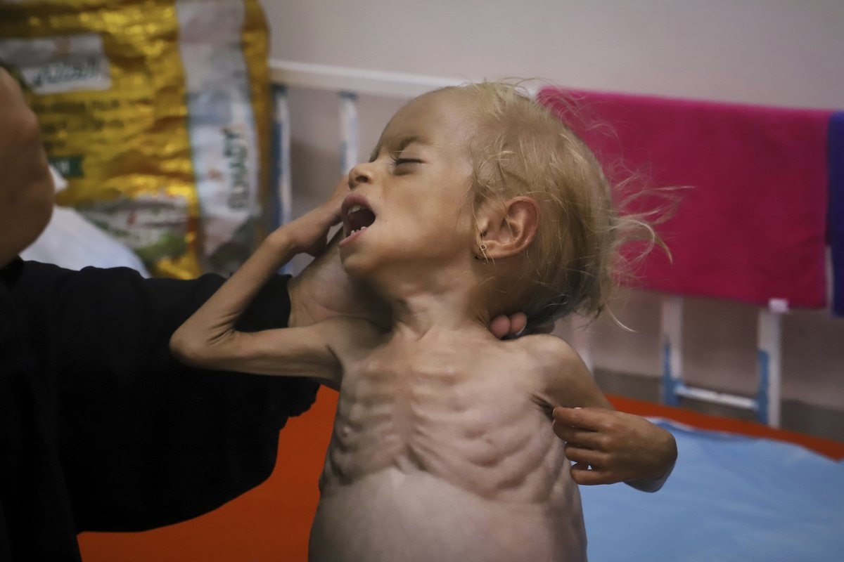 Malnourished Kids Arrive Daily at a Gaza Hospital as Netanyahu Denies Hunger