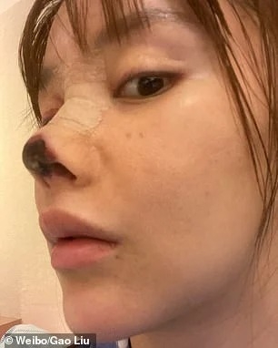 خضعت لعملية تجميل في أنفها فأصبح أسود ومتعفن... ممثلة شهيرة ضحية "كبير الجراحين"