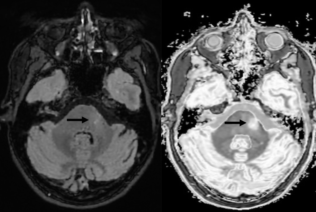 MRI Method Uncovers Invisible MS Lesions