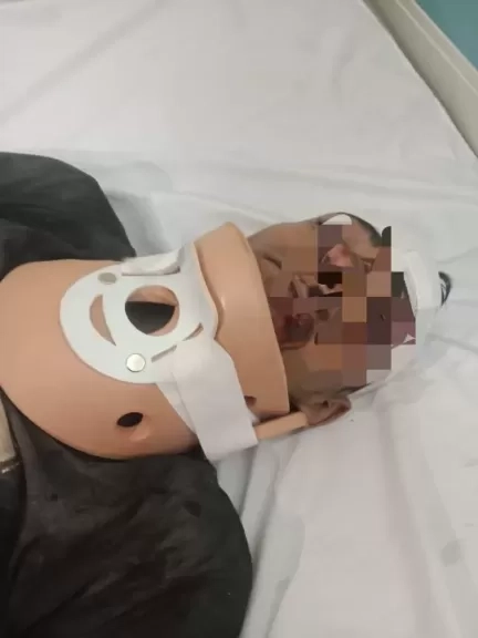 للمرة الأولى بـ' صحة الدقهلية'.. نجاح جراحة دقيقة لإصلاح كسر بالرقبة في تمى الأمديد'