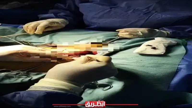لأول مرة.. تسليك شرايين بقسطرة شريانية وتركيب فلتر وريدي بمستشفى ادكو المركزي