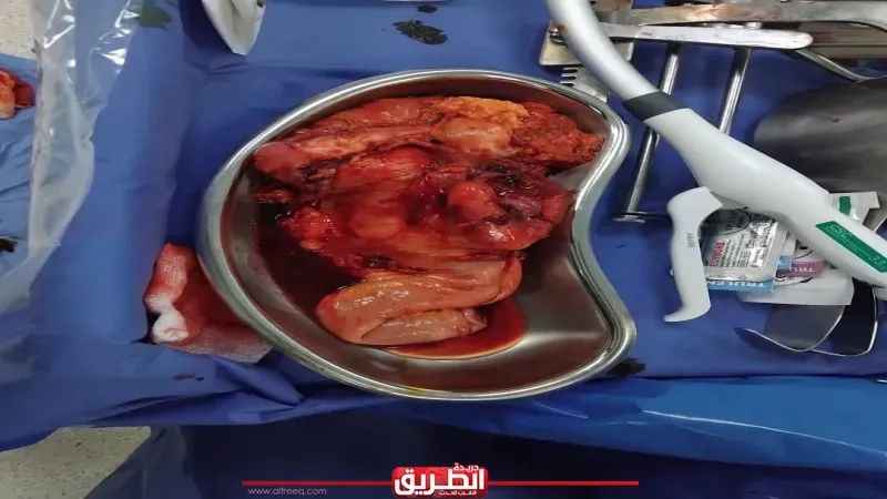 نجاح جراحة دقيقة لاستئصال ورم بالقولون لمُسن في المجمع الطبي بطنطا