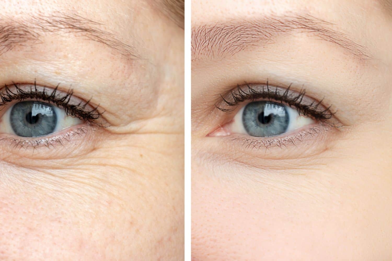 Getting help with Botox