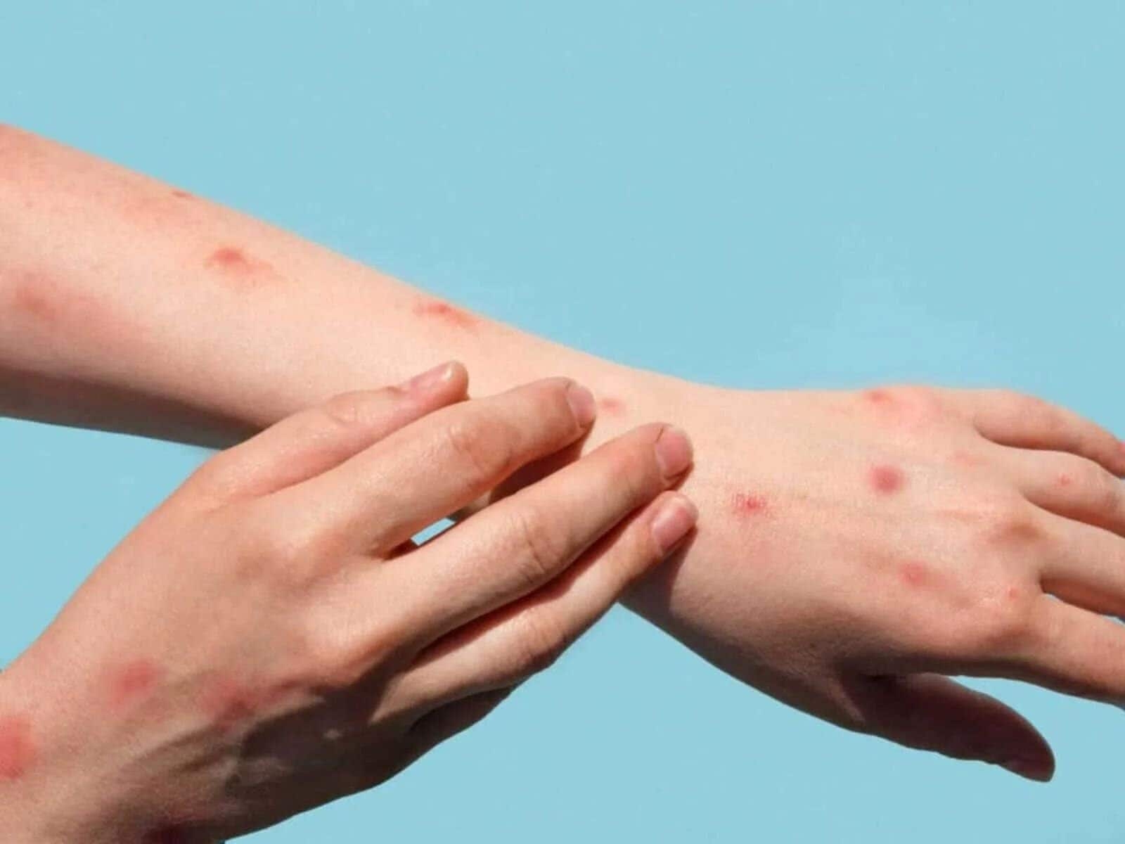 Health Department warns number of mpox cases rising in SA
