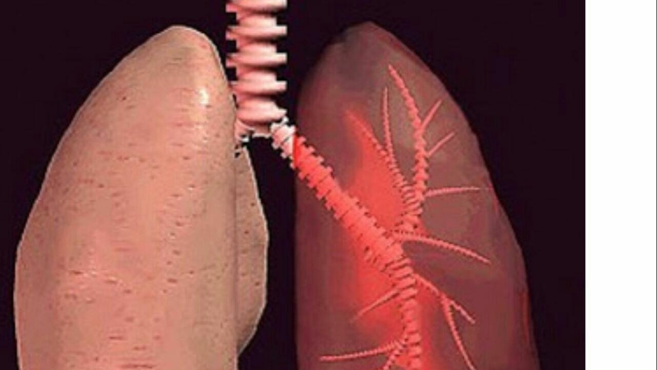 من الفيروس إلى التليف.. كيف يبدأ المرض الخفي في تدمير الرئة؟