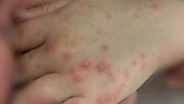 استشاري طب الأطفال يحذر: لا تعطوا الأسبرين للأطفال المصابين بهذا الفيروس المنتشر