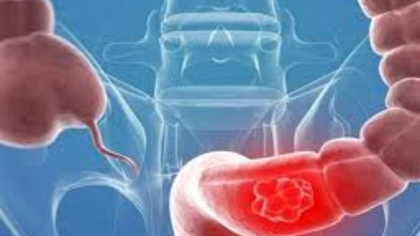 3 طرق سهلة للوقاية من سرطان القولون