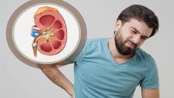 مشروبات طبيعية تساعد في طرد أملاح وحصوات الكلى