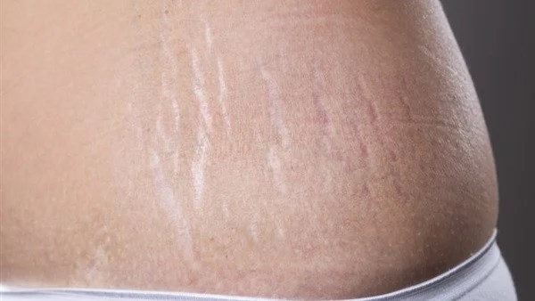 السترتش ماركس..هل يمكنك التخلص منها؟