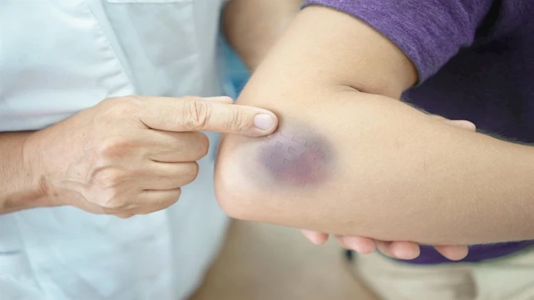 أسباب ظهور الكدمات الزرقاء على الجسم فجأة.. اعرف السر