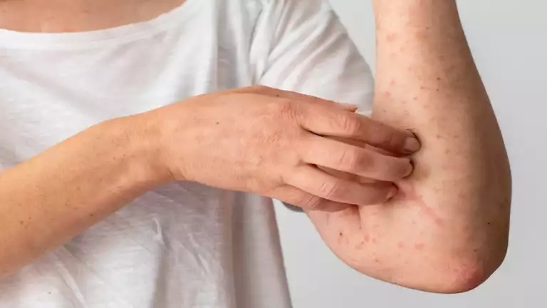علماء يطورون نموذج ذكاء اصطناعي لتشخيص الإكزيما
