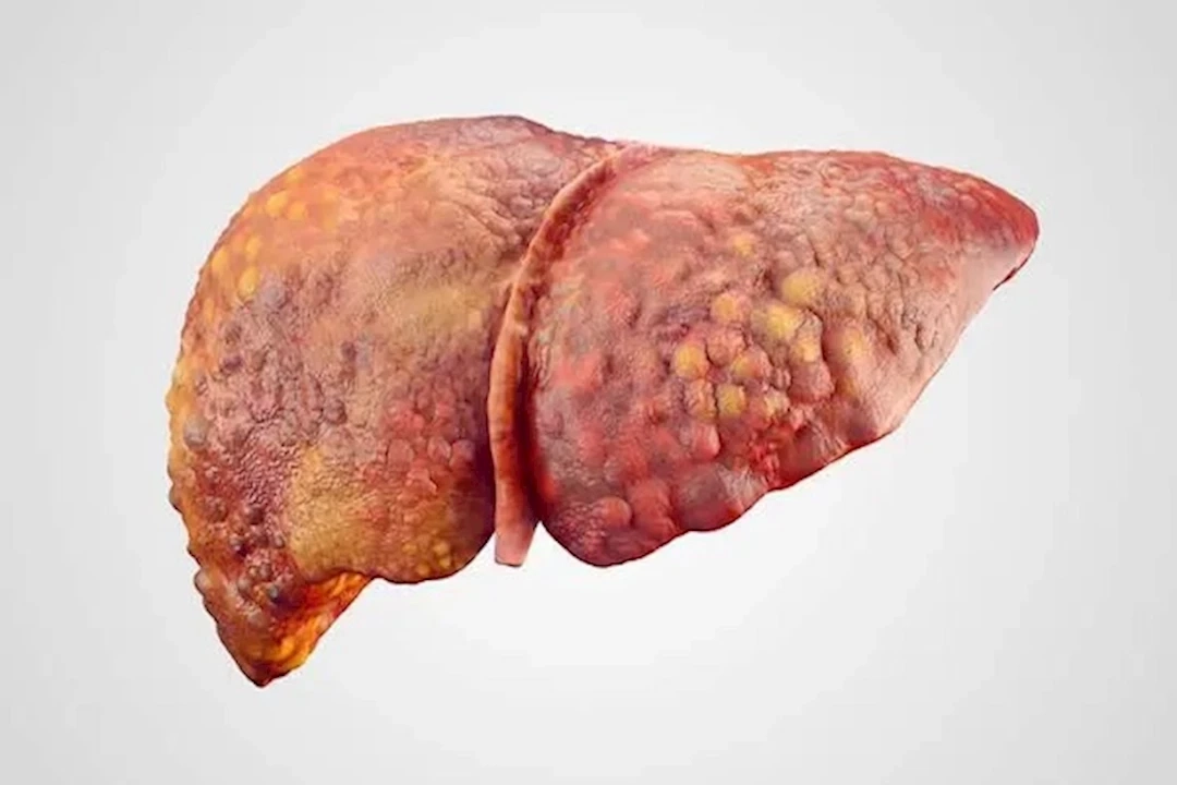 احذرها.. 7 علامات مبكرة تكشف تليف الكبد