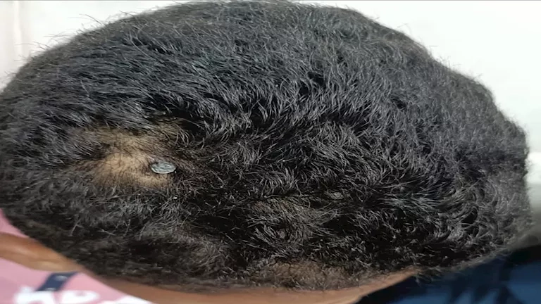 العملية استغرفت 5 ساعات.. استخراج مسمار اخترق رأس طفل في الفيوم- صور