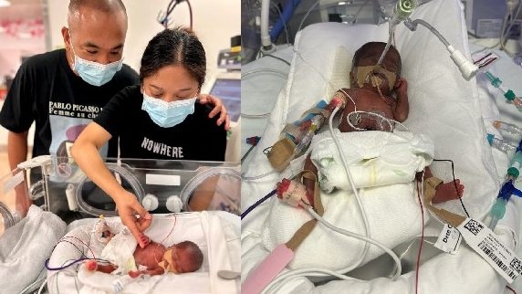 Singapore nurse faces close to a million dollars in medical bills after long-awaited baby is born premature at 25 weeks