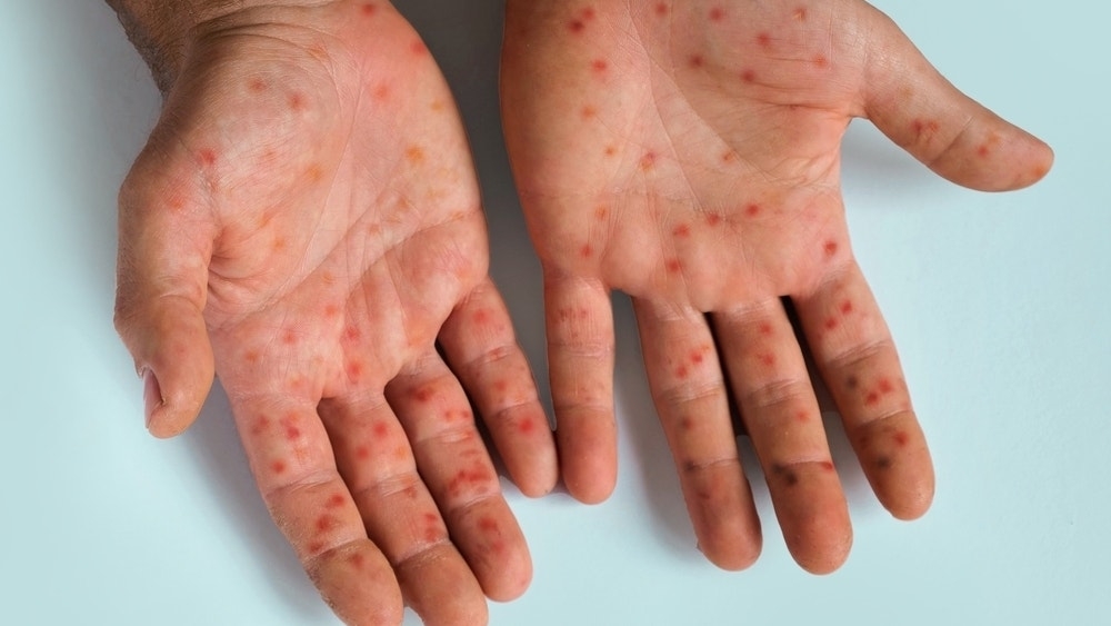 Kymera Therapeutics Says Atopic Dermatitis Potential Matches Sanofi/Regeneron's Blockbuster Dupixent In Early Biomarker Response