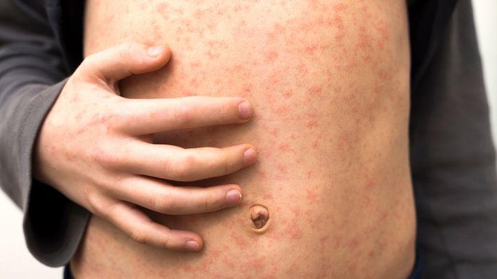 Measles holiday warning as cases rise in Europe