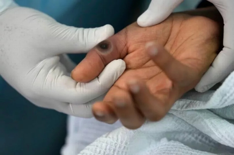 UKHSA update on 'severe' mpox after new case detected in UK