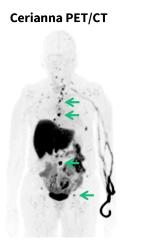 Updated NCCN Clinical Practice Guidelines in Oncology (NCCN Guidelines®) Recommend Use of FES PET Imaging for Lobular Breast Cancer