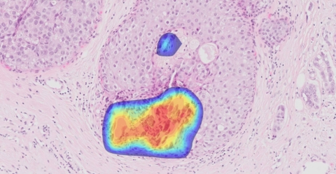 AI-Driven Accuracy and Efficiency in Breast Cancer Diagnosis: New Study Validates Ibex Breast Solution