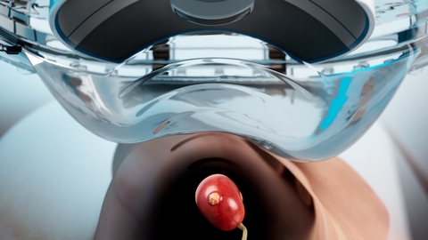 HistoSonics Completes Enrollment in #HOPE4KIDNEY Trial Evaluating Non-Invasive Histotripsy to Treat Kidney Tumors