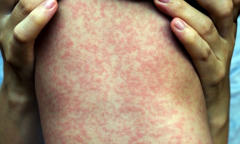 Kitchener high school closed after measles exposure, cases in Waterloo region climb to 59