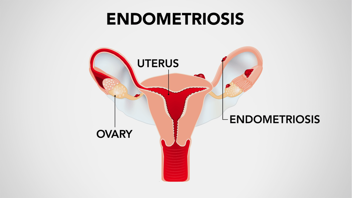 Meet a woman navigating life with endometriosis